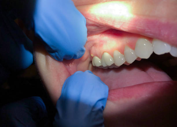 Best Lost Filling or Crown Replacement in Le Roy, IL